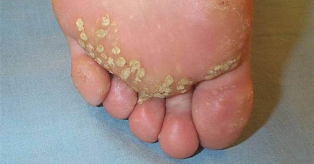 Which Hpv Causes Verrucas?