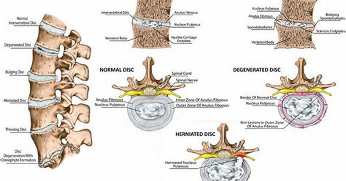 Which Intervertebral Discs Are Most Likely to Be Herniated?