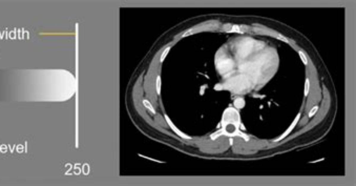 Which Is a Typical Soft Tissue Window Setting