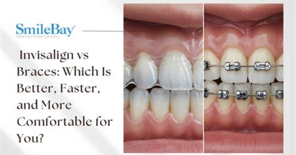 Which Is Faster Braces or Invisalign?