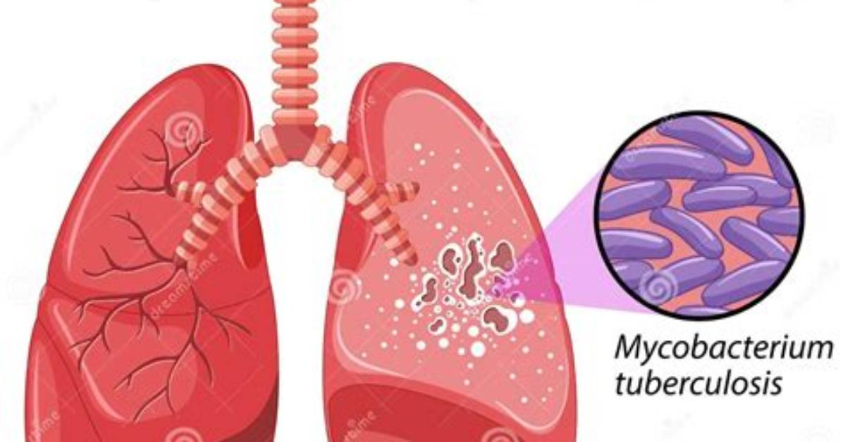 Which Is Infected by Tuberculosis?