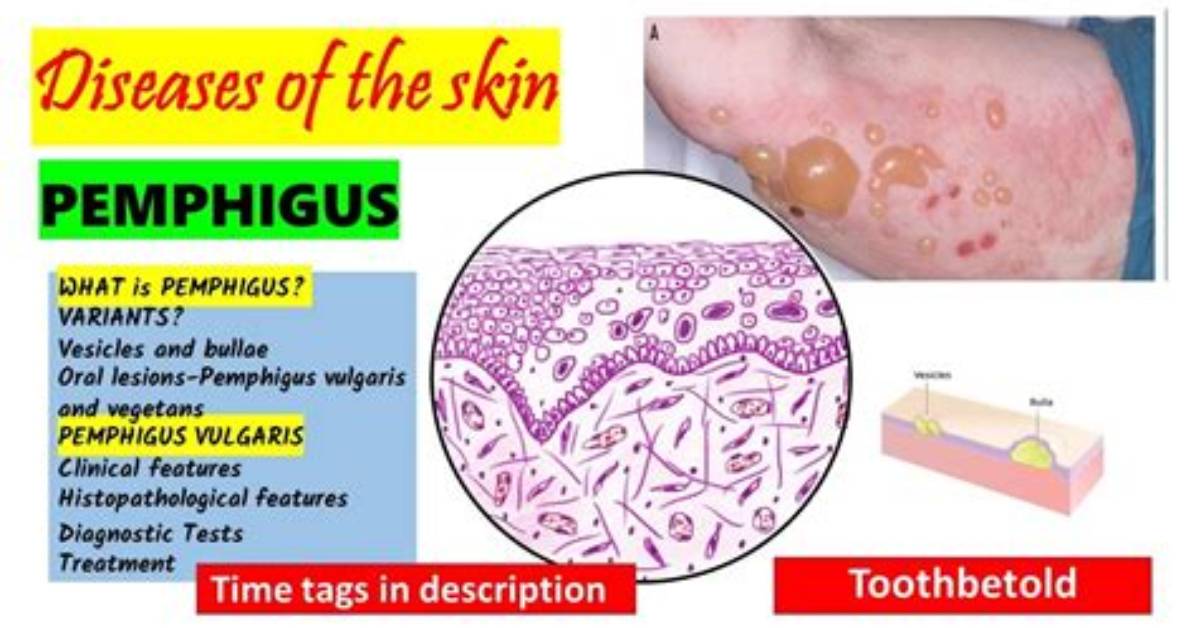 Which Layer Does Pemphigus Vulgaris Affect?