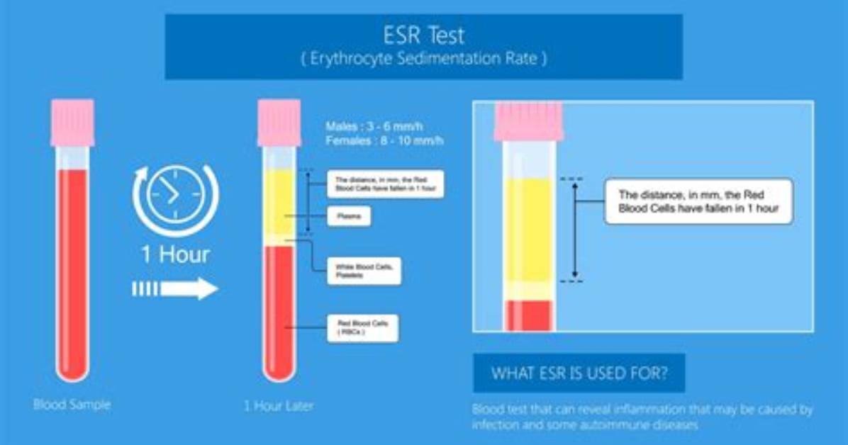 Which Method Is Best for Esr
