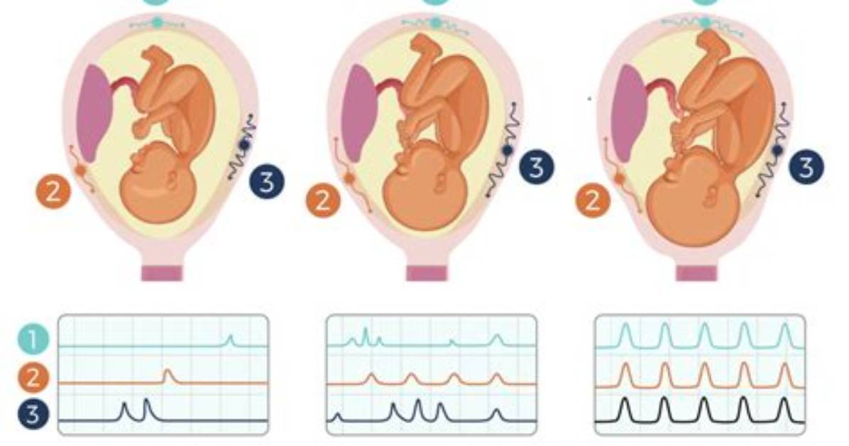 Which Month Contractions Start?