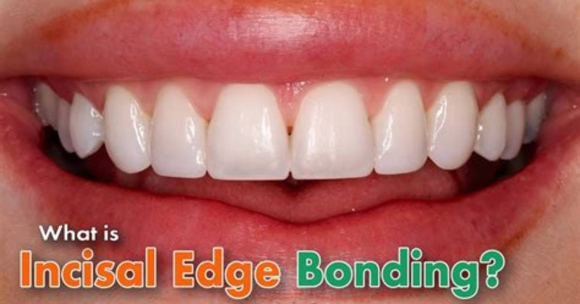 Which Teeth Have an Incisal Edge