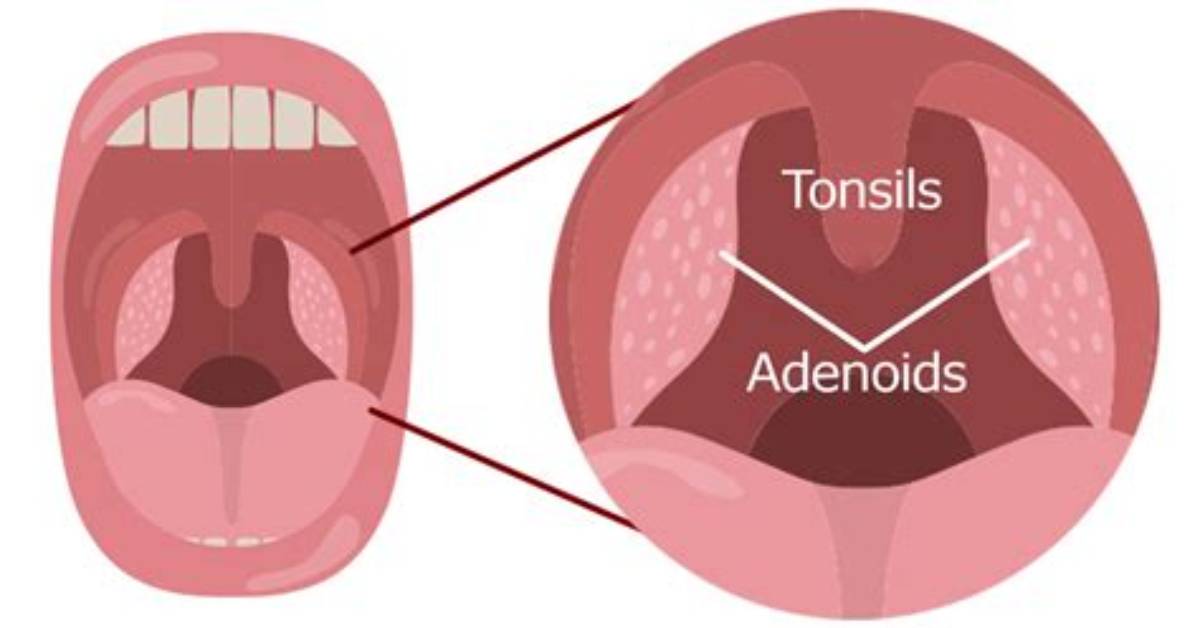 Which Tonsils Are Adenoids?