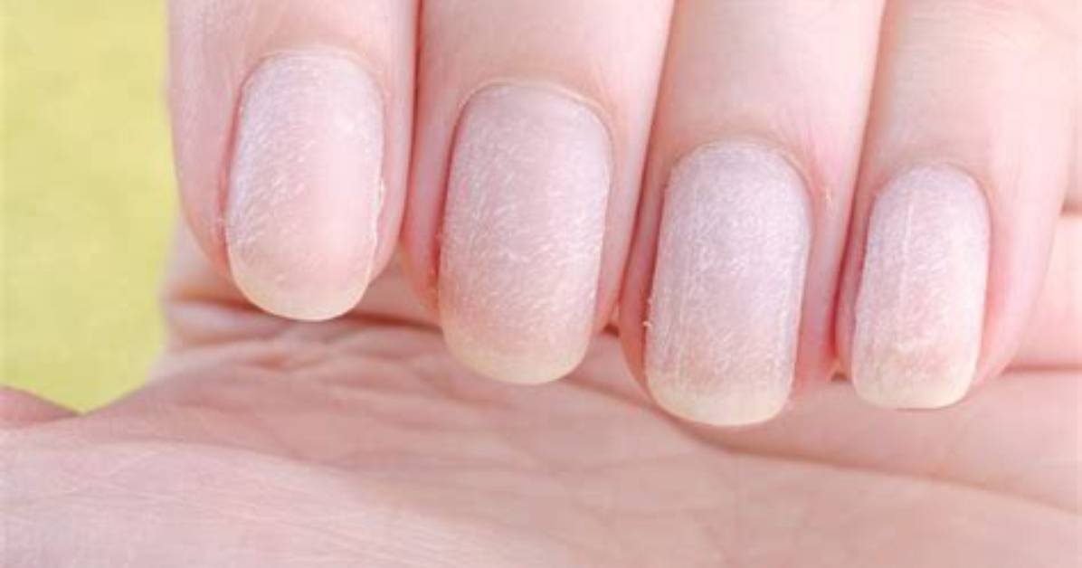Which Vitamin Deficiency Causes Hangnails?