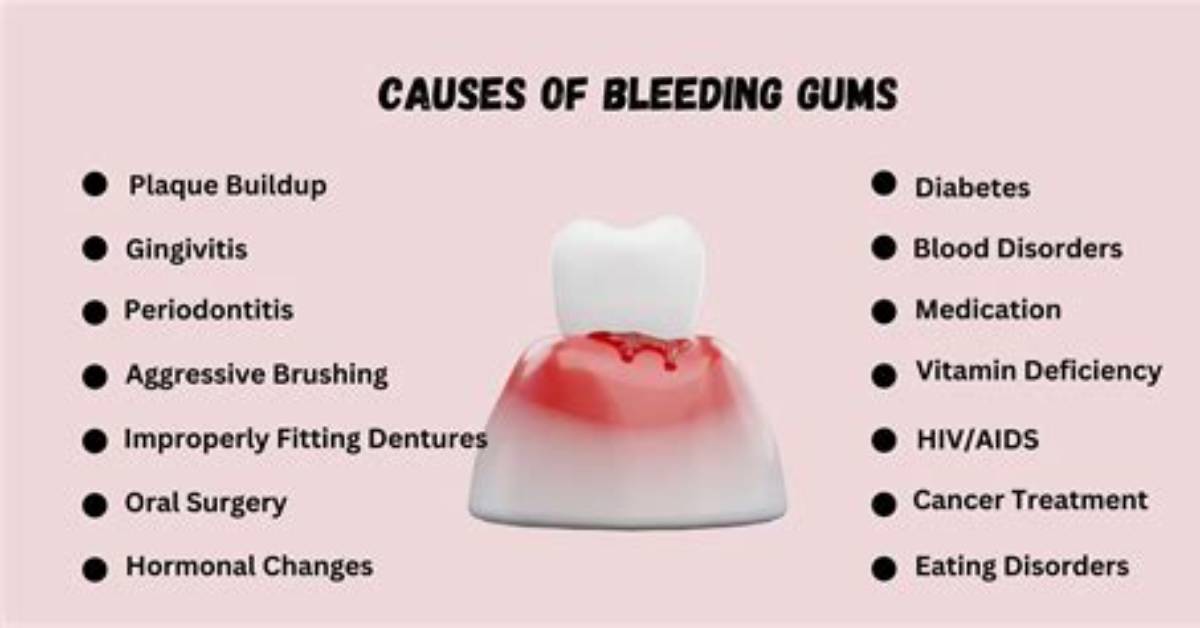 Who Do Gums Bleed?