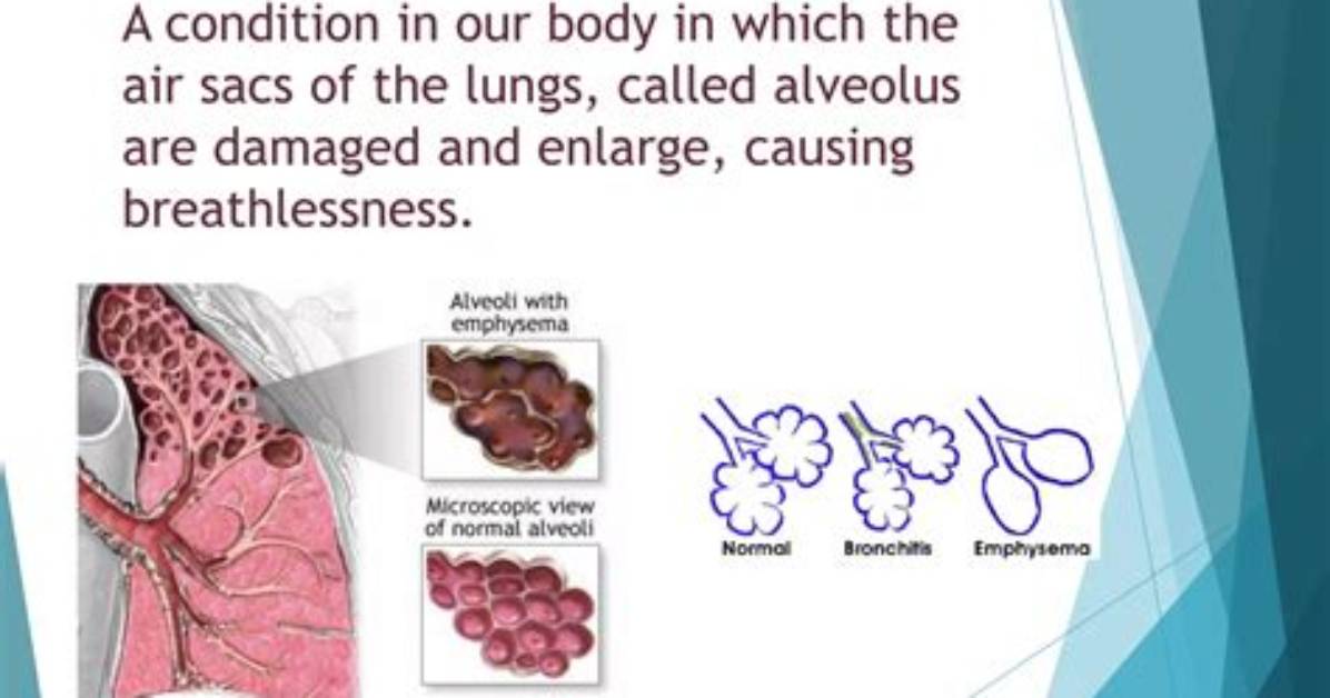 Who Does Emphysema Affect the Body?