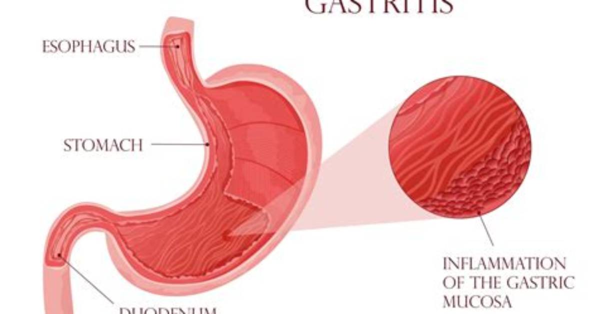 Who Does Gastritis Affect?