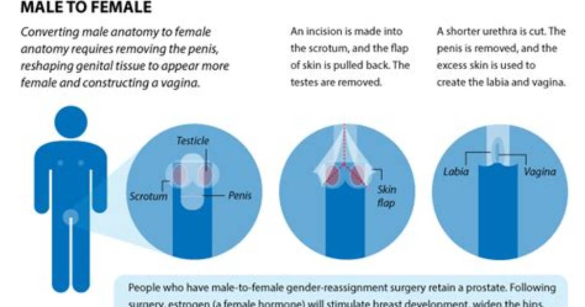 Who Does Gender Reassignment Surgery?