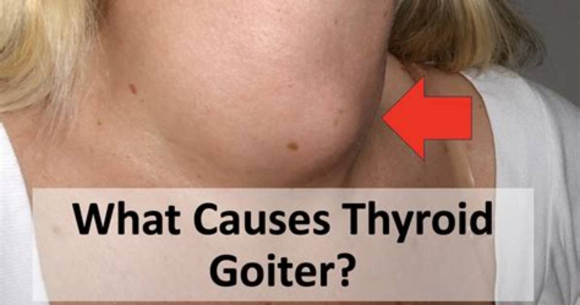 Who Does Goiter Affect the Most?