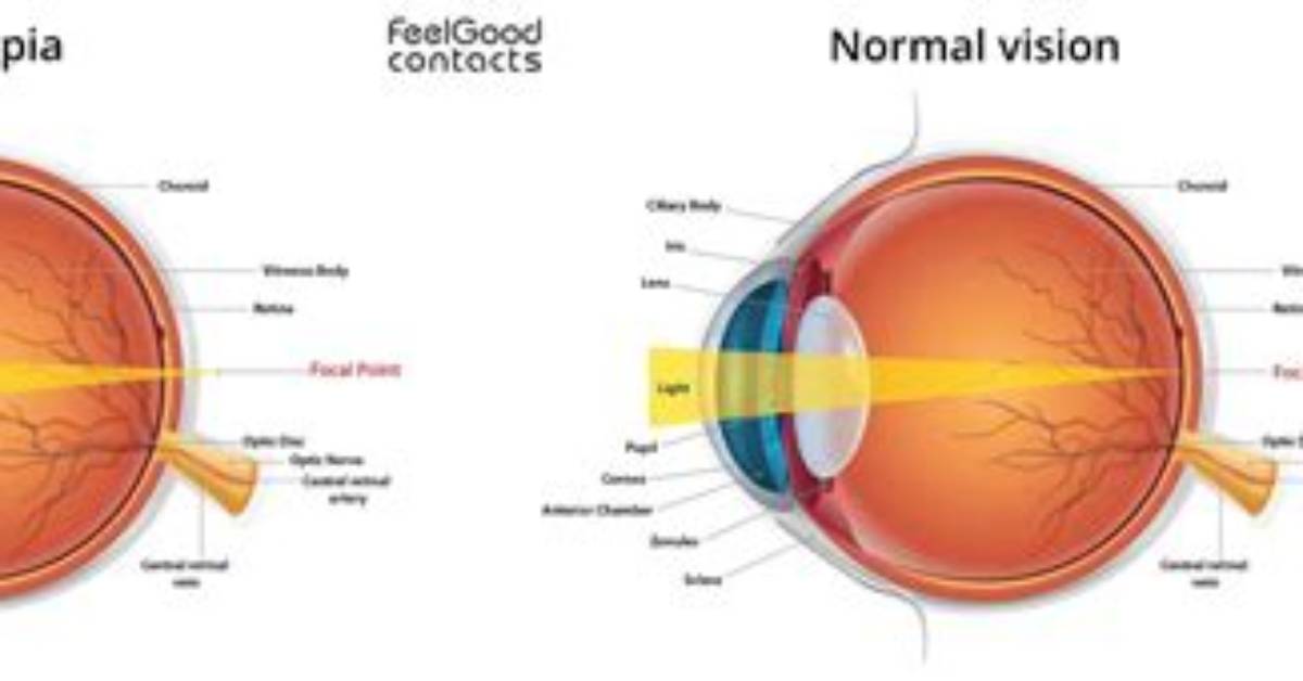 Who Does Hyperopia Affect?