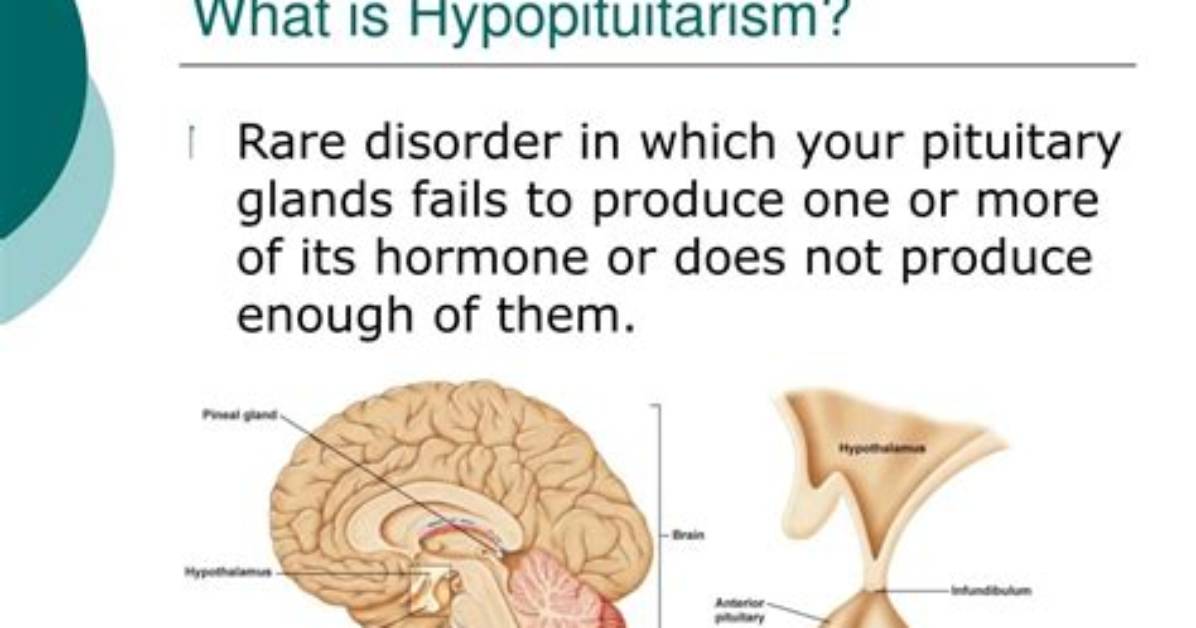 Who Does Hypopituitarism Affect?