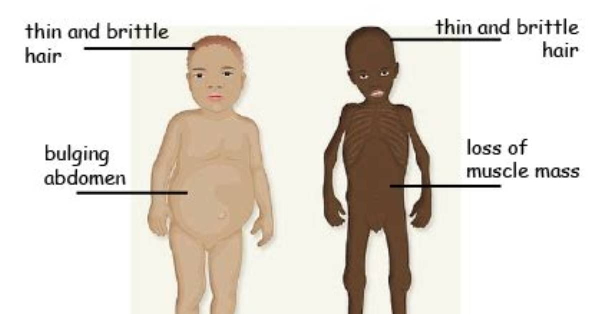 Who Does Malnourished Mean?