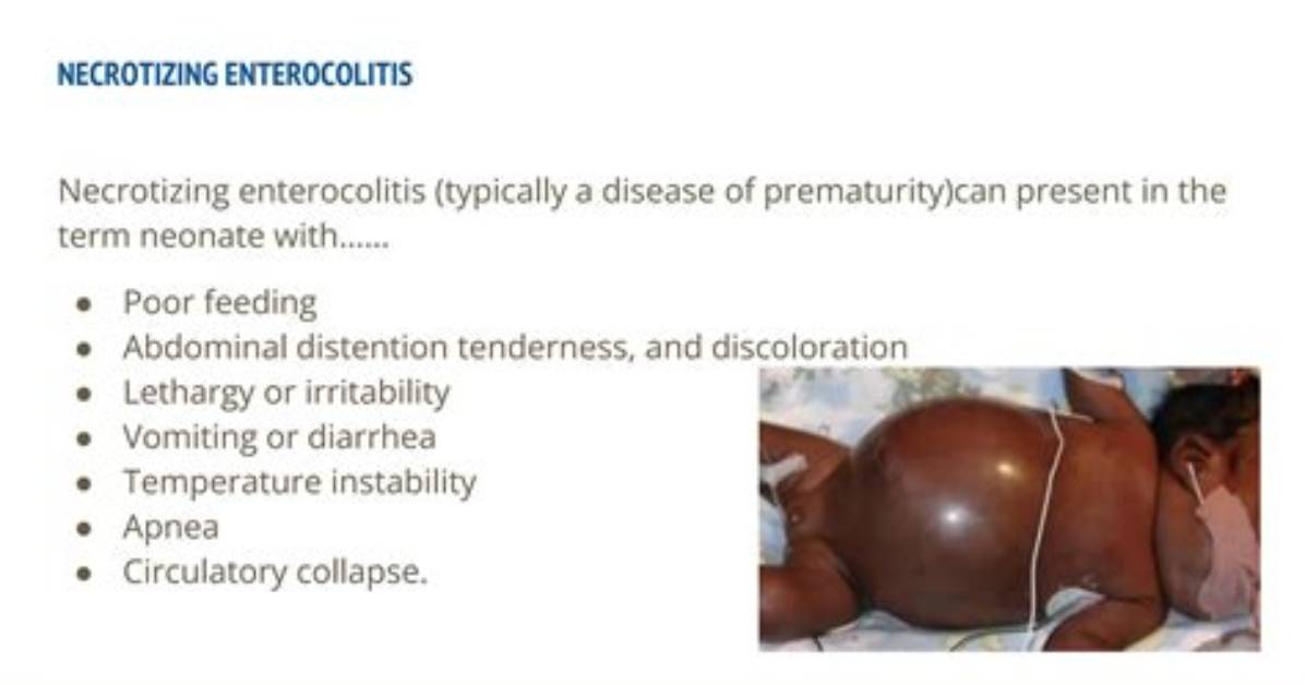 Who Does Necrotizing Enterocolitis Affect?