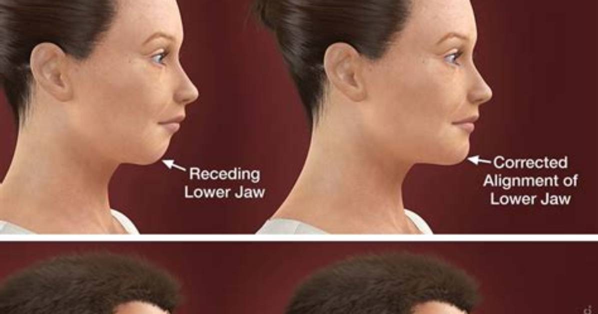 Who Does Orthognathic Surgery?