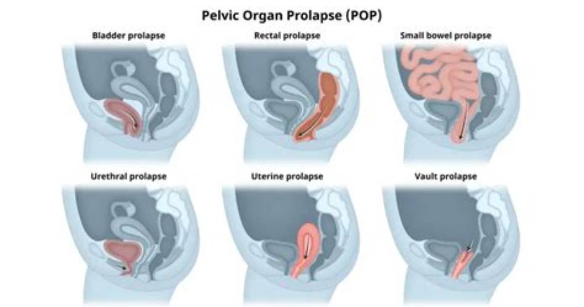 Who Does Prolapse Surgery?