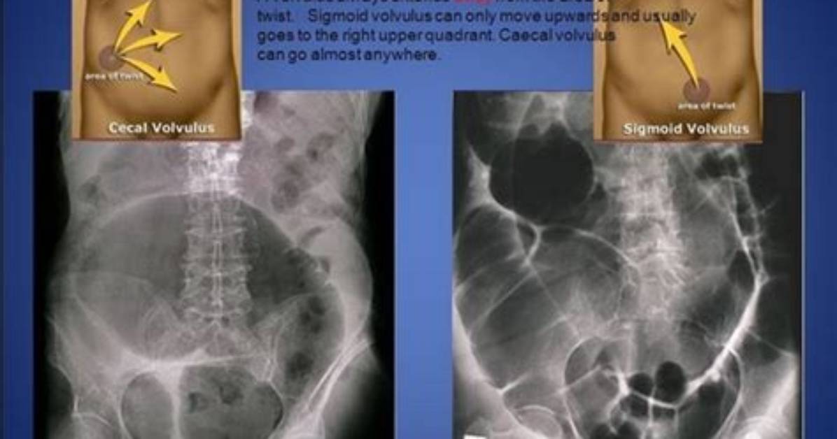 Who Gets Cecal Volvulus?