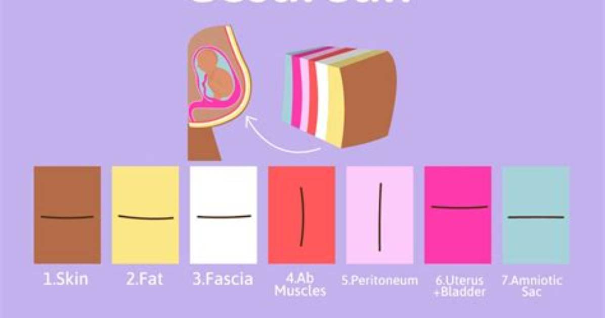 Who Is a C-Section?