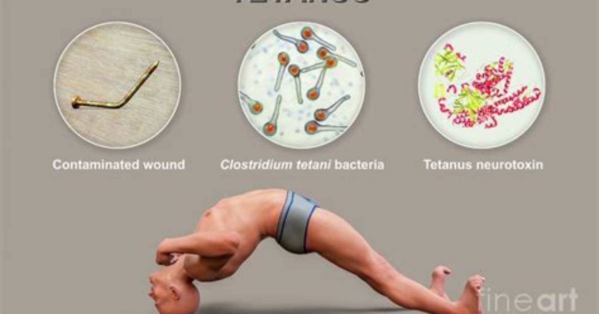 Who Is Likely to Develop Tetany?