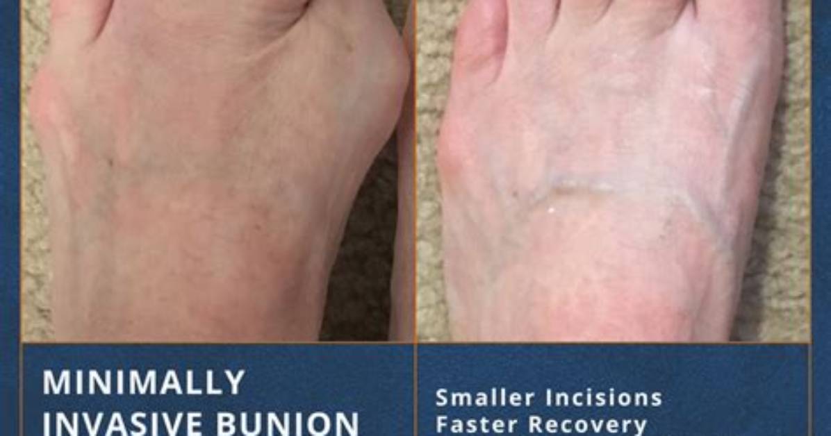 Who Needs Bunion Surgery?