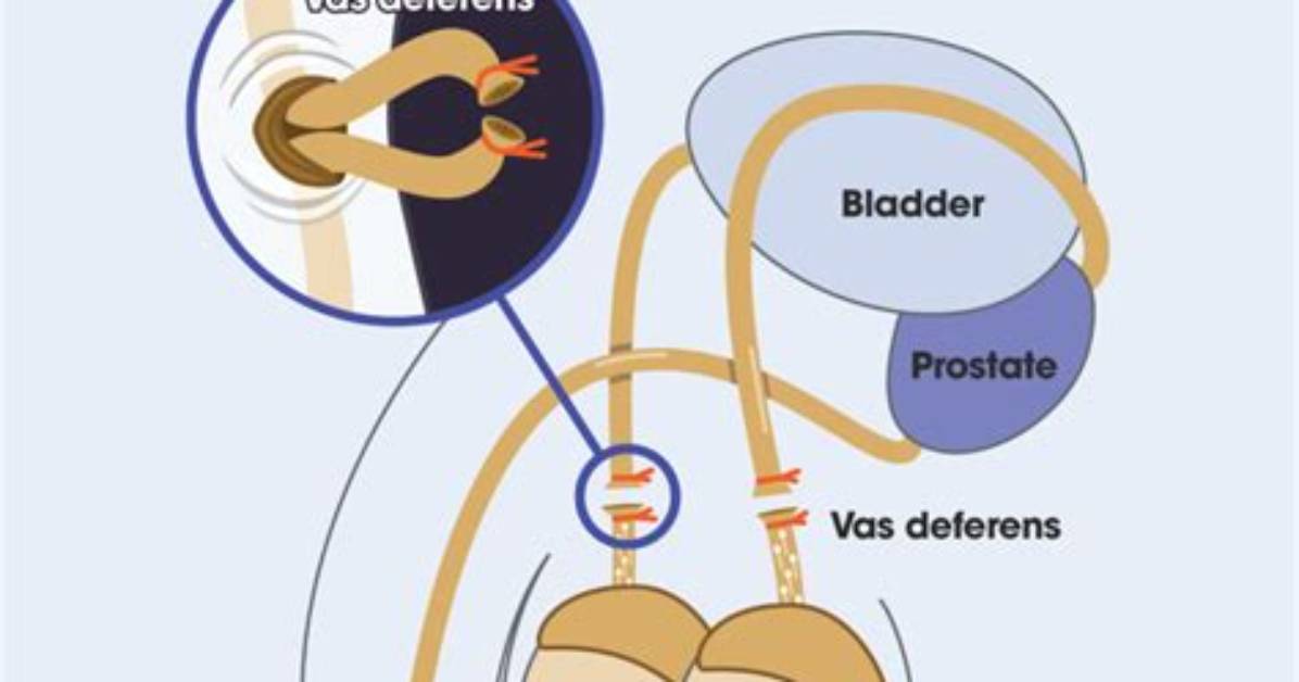 Who Performs a Vasectomy?