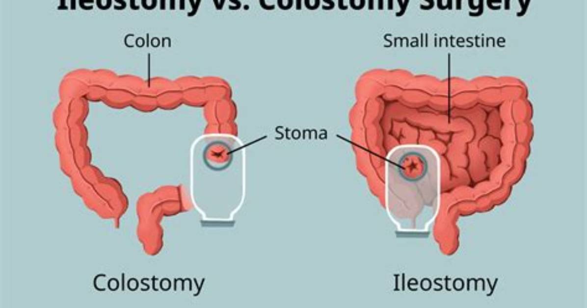 Who Performs Ostomy Surgery?