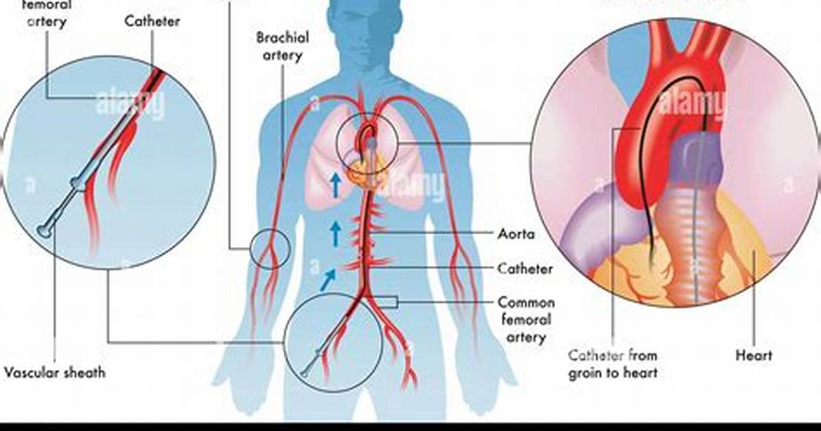 Why Angiogram Is Done?