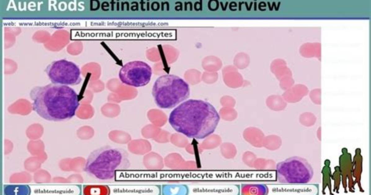 Why Are Auer Rods Formed