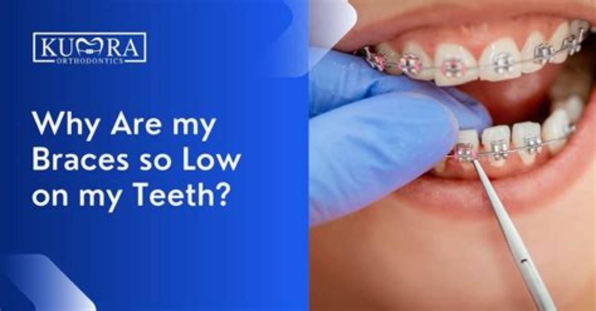 Why Are Braces So Sharp?