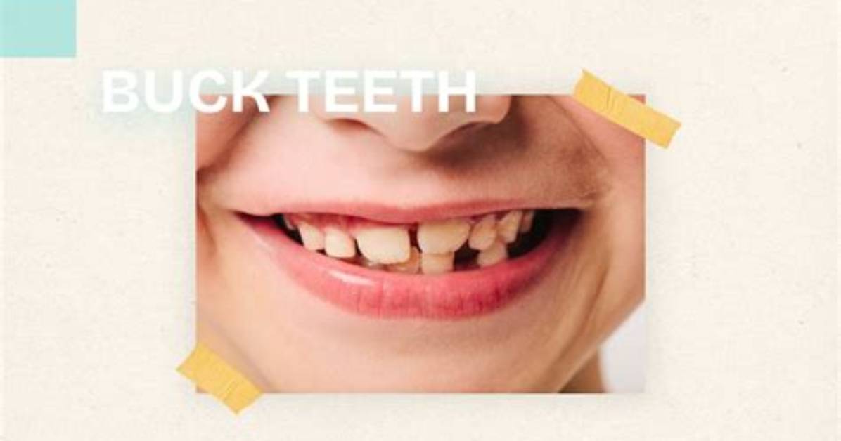 Why Are Buck Teeth Called Buck Teeth?