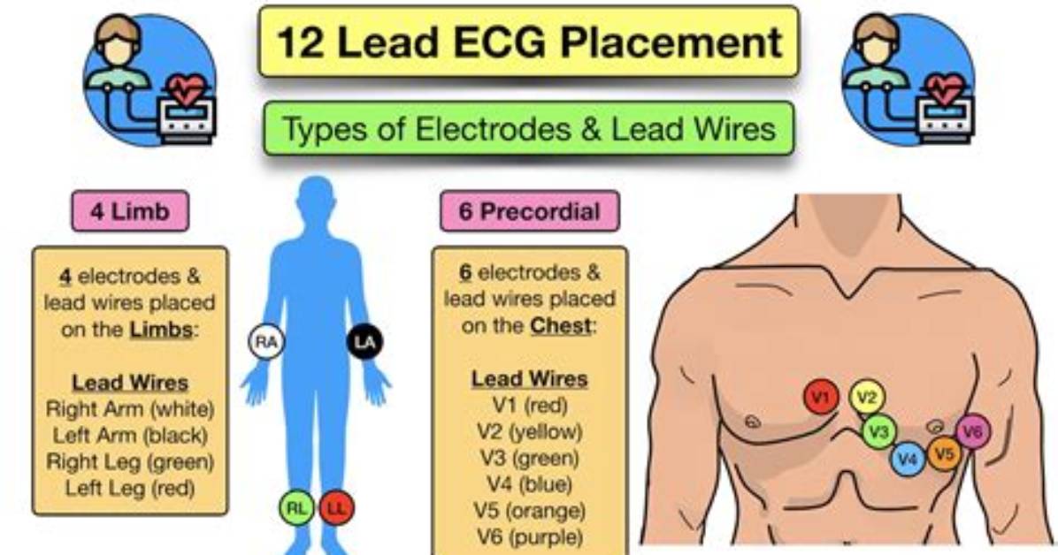 Why Are Electrodes Placed in Ecg