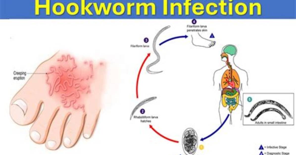 Why Are Hookworms Called Hookworms?