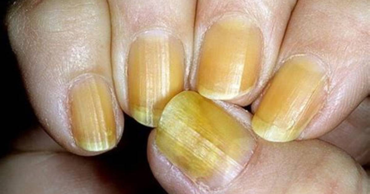 Why Are My Nails Orange