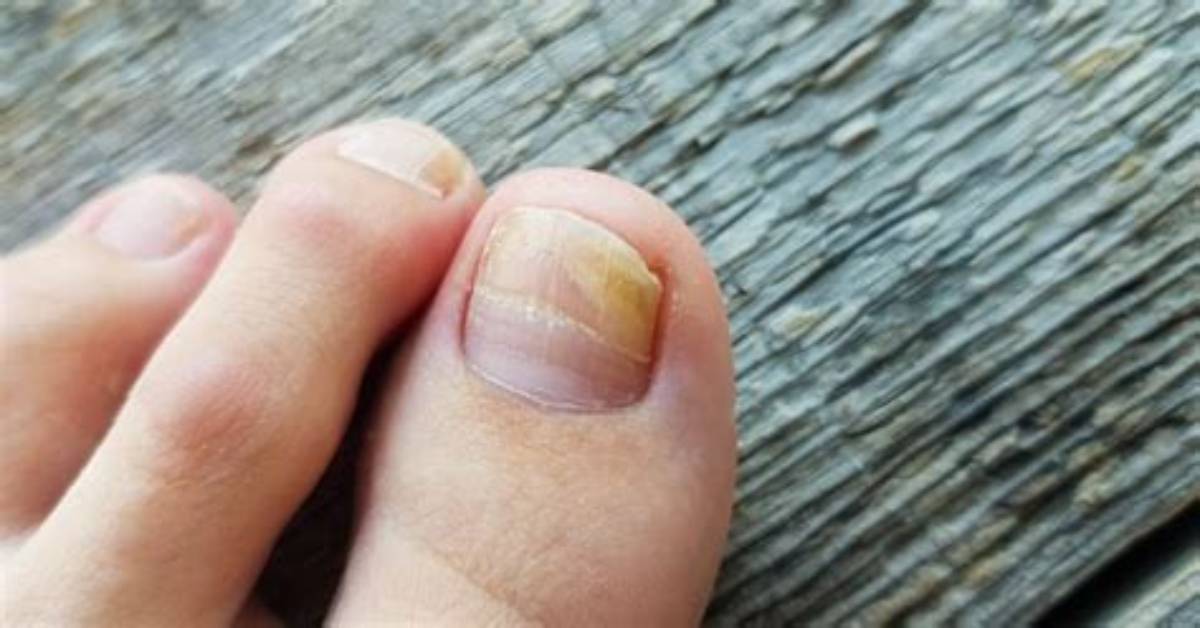 Why Are My Toenails Yellow