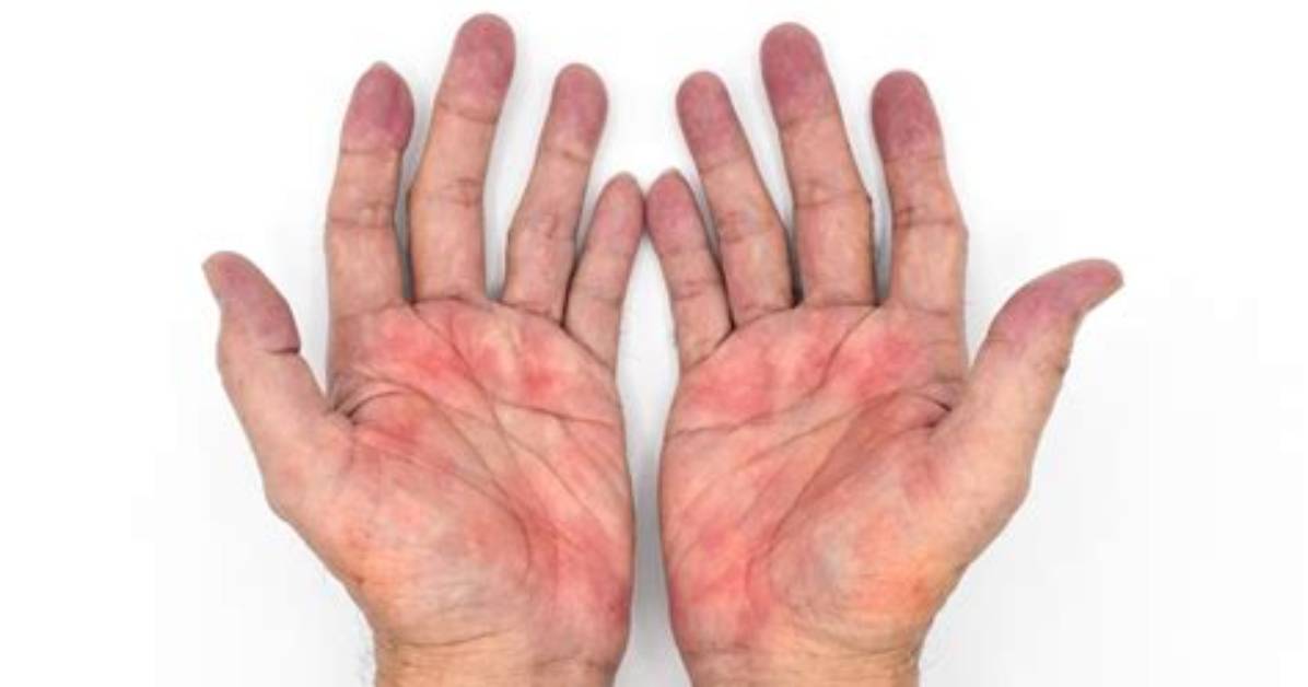 Why Are Palms Red?