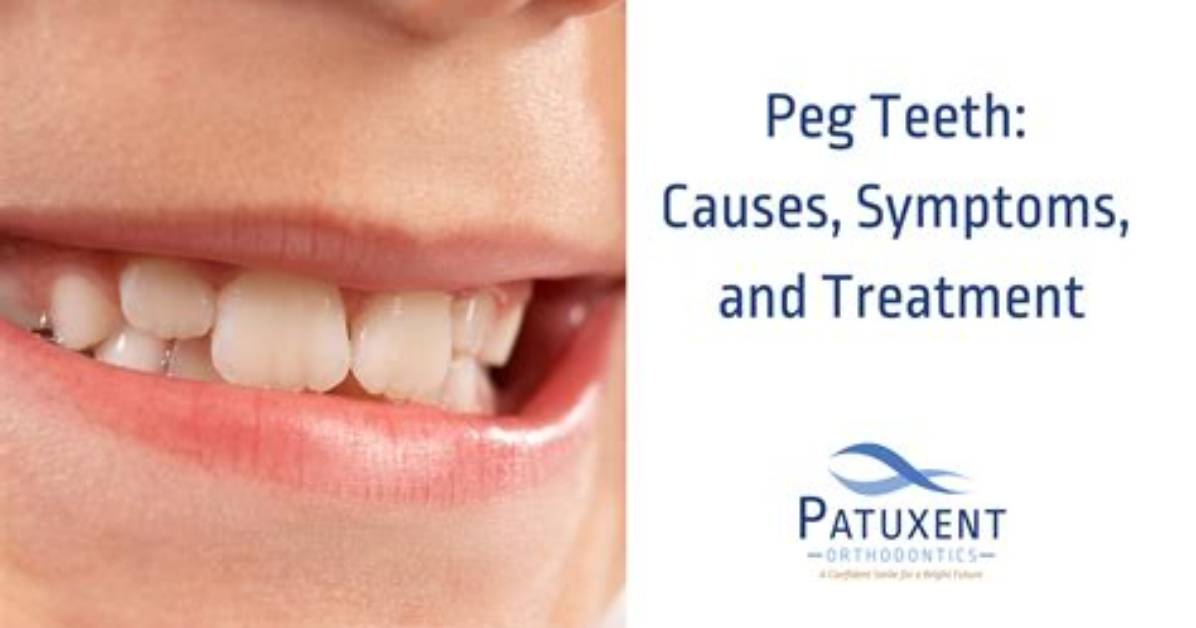 Why Are Teeth Called Pegs?