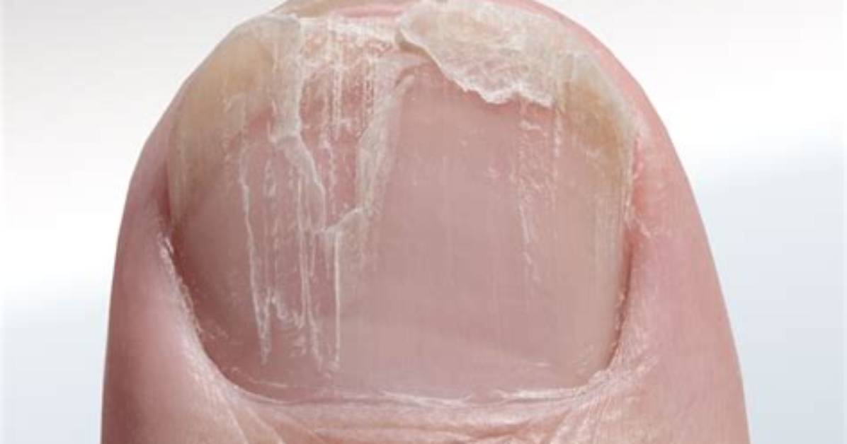 Why Are Toenails Brittle?