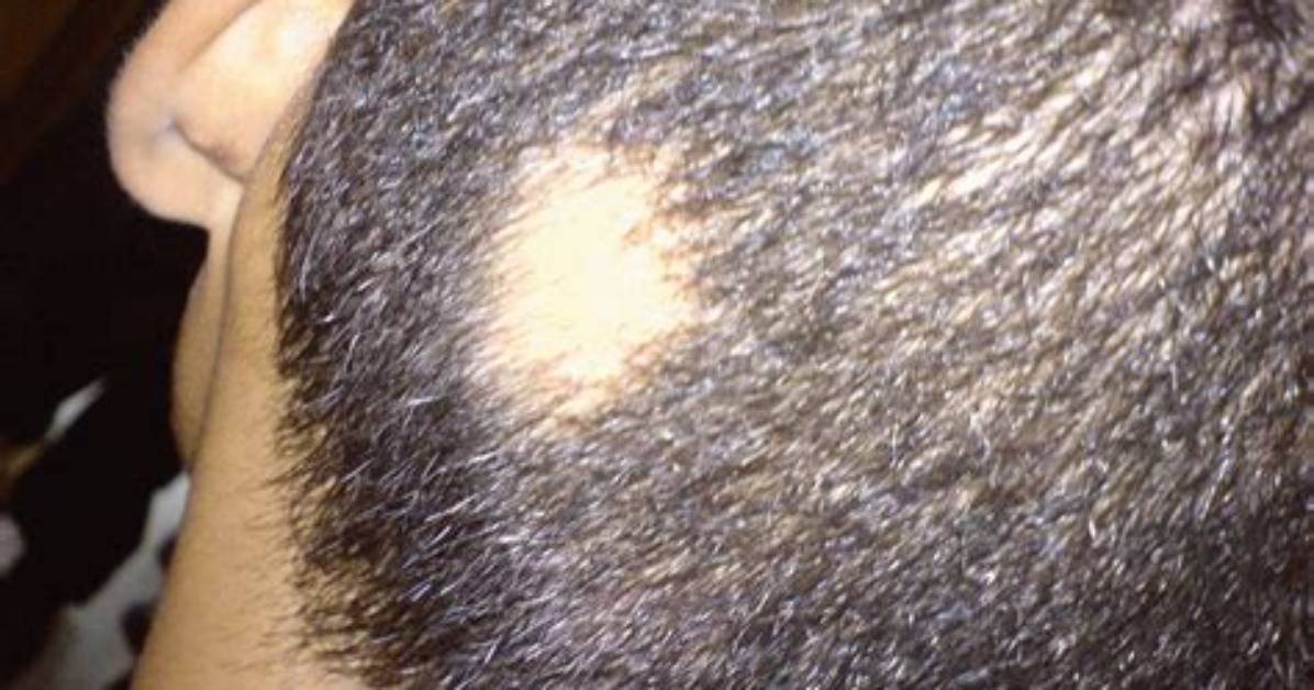 Why Bald Spot on Head?