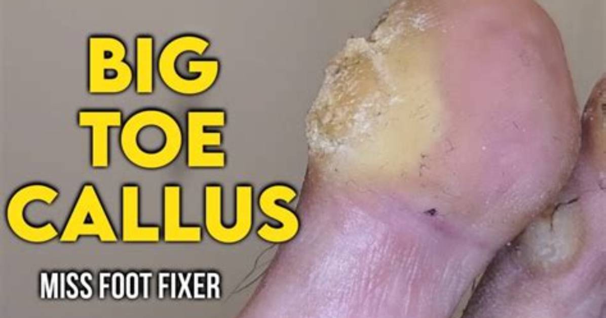 Why Callus on Big Toe?