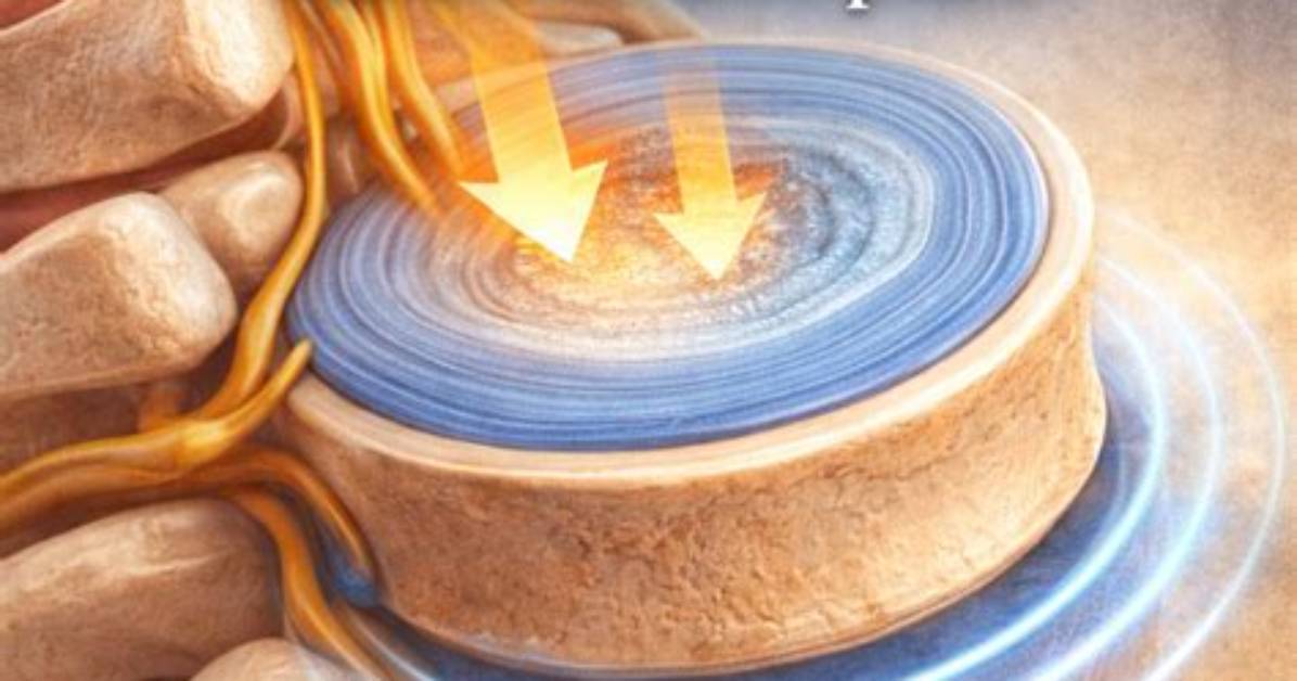 Why Can Intervertebral Discs Absorb Shock?
