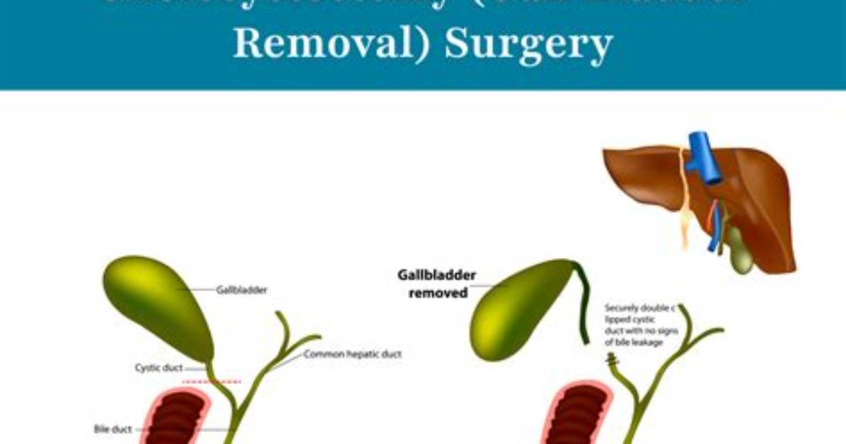 Why Cholecystectomy Is Done?