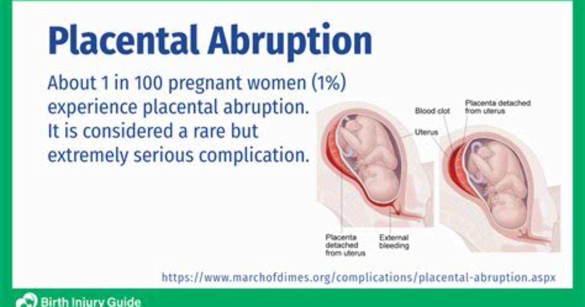 Why Dic Occurs in Abruptio Placentae?