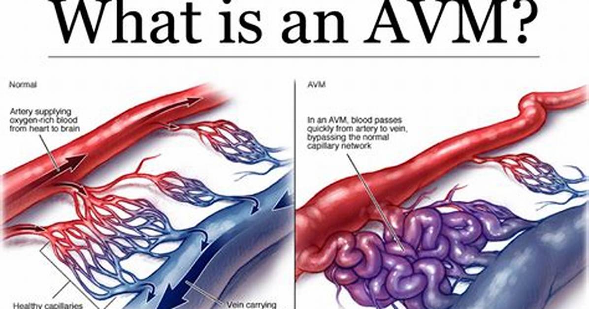 Why Do Arteriovenous Malformation Happen?