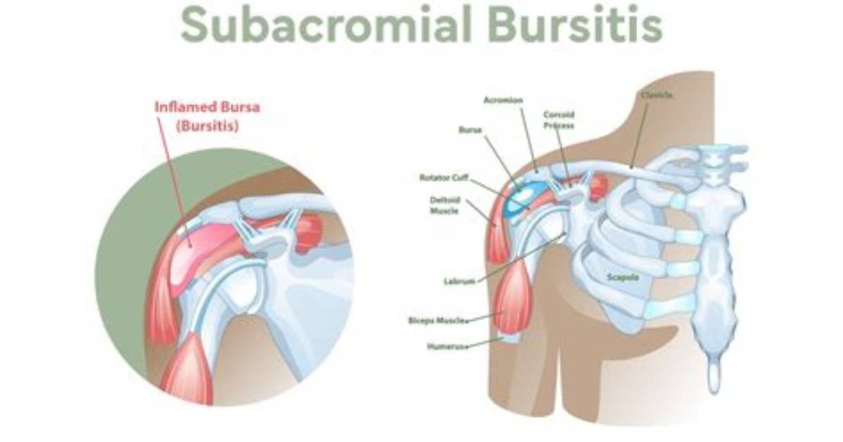 Why Do Bursa Sacs Get Inflamed?