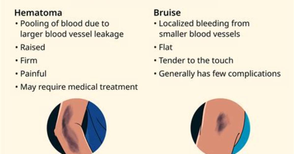 Why Do Cannulas Bruise?