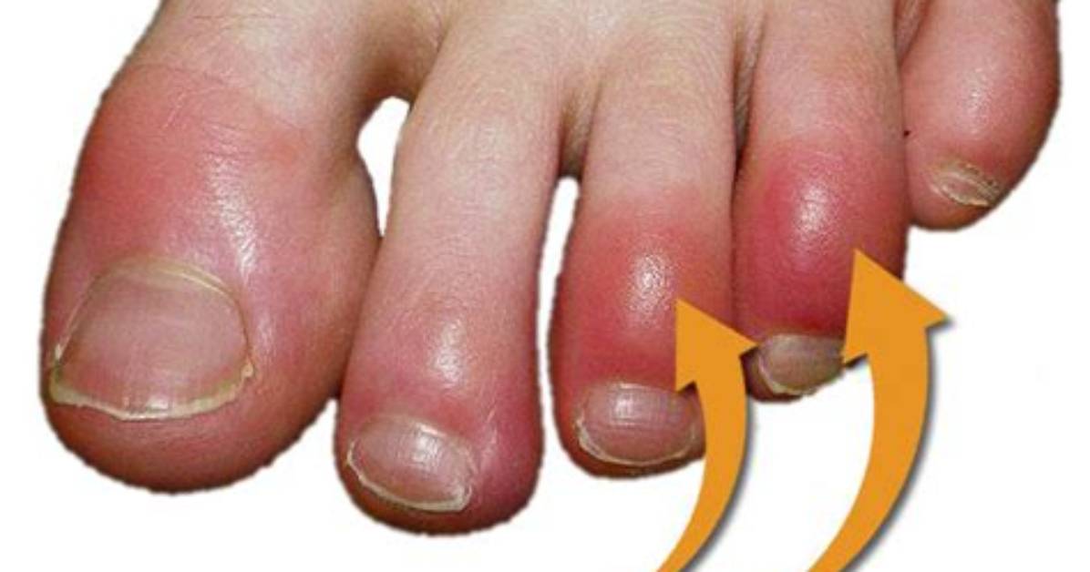 Why Do Chilblains Hurt?