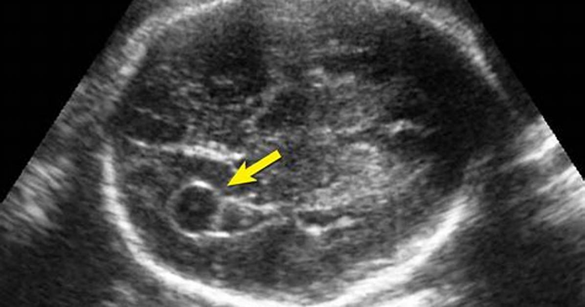 Why Do Choroid Plexus Cyst Form?