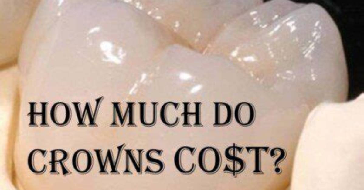 Why Do Crowns Cost So Much?